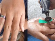 Jari Bengkak karena Cincin Stainless, Remaja di Ciamis Minta Bantuan Damkar Jari-Bengkak-karena-Cincin-Stainless.jpg