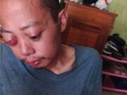 Penderita Tumor Mata di Pamarican Ciamis Butuh Bantuan untuk Pengobatan Penderita-Tumor-Mata-di-Pamarican-Ciamis-Butuh-Bantuan-untuk-Pengobatan.jpg